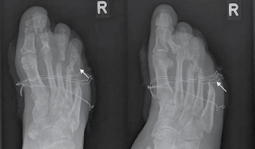 RTG stopy w projekcji grzbietowo-podeszwowej i skośnej. Znaczne pogrubienie cienia tkanek miękkich palca I. Osteoliza paliczka dystalnego pierwszego promienia.