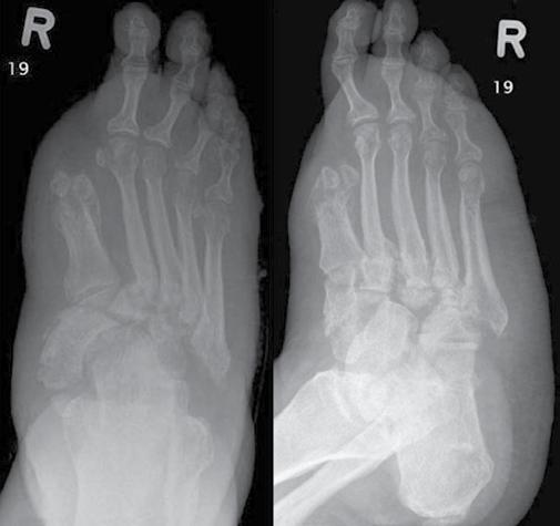 Zespół stopy cukrzycowej neuroosteoartropatia Charcota czy zapalenie kości? Część I: Obraz kliniczny i radiogramy Ryc. 8. Zdjęcie RTG stopy prawej w projekcji grzbietowo-podeszwowej i skośnej.