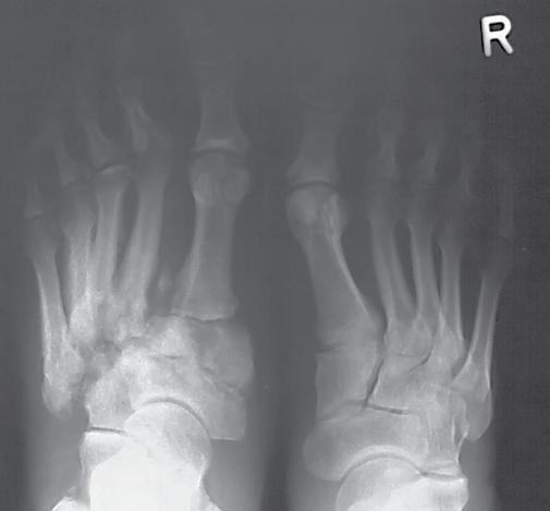 Destrukcja kostna oraz liczne przemieszczenia w obrębie kości stępu w przebiegu neuroosteoartropatii Charcota Ryc. 9. Zdjęcie RTG stopy w projekcji grzbietowo-podeszwowej i skośnej.