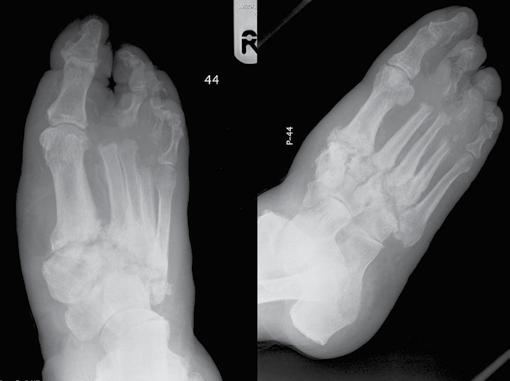 Zdjęcie RTG stopy prawej w projekcji grzbietowo-podeszwowej i skośnej. Rumowisko kostne w obrębie kości stępu w przebiegu neuroosteoartropatii Charcota.