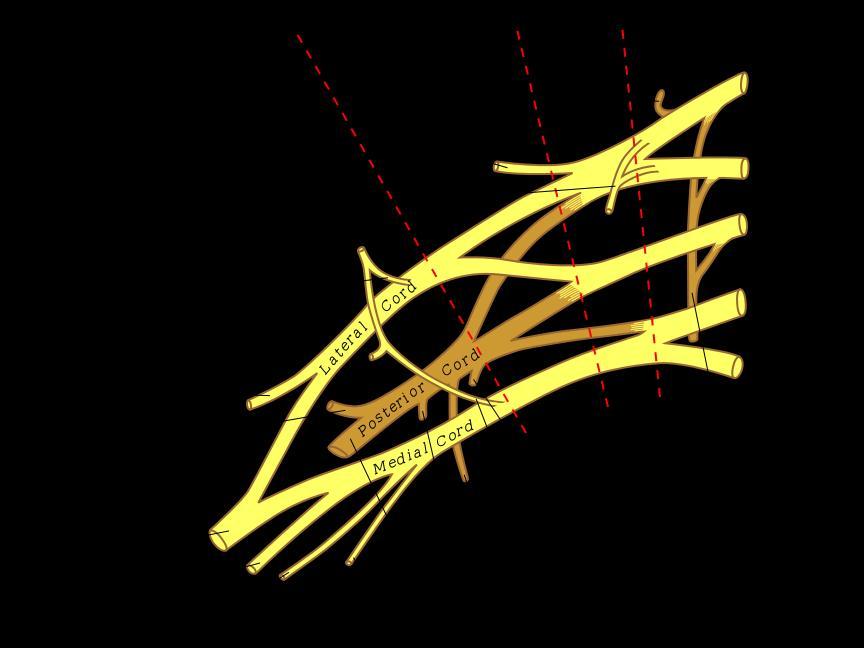 Splot ramienny Gałęzie sploty ramiennego zaopatrują skórę i mięśnie kończyn górnych oraz część mięśni klatki