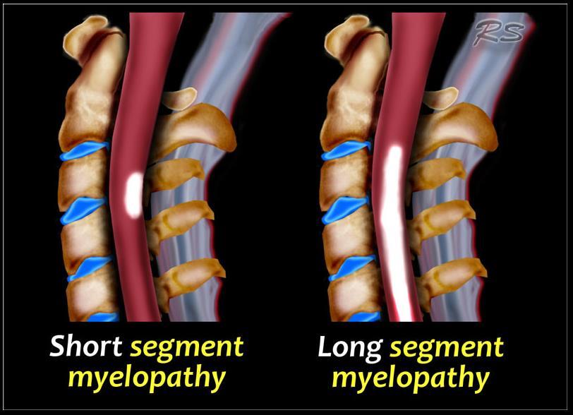 Poprzeczne zapalenie rdzenia SM SID Odcinek szyjny Odcinek
