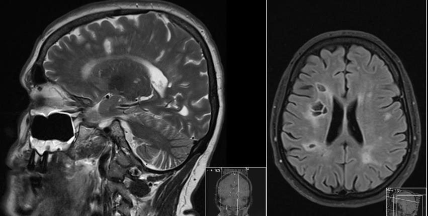 Toczeń rumieniowaty układowy Bóle głowy, napady padaczkowe, objawy psychiatryczne, ruchy pląsawicze, zajęcie