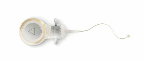 chroniczne zapalenie ucha zewnętrznego) uniemożliwiają używanie aparatów słuchowych. Implant systemu SOUNDBRIDGE bezpośrednio stymuluje struktury anatomiczne ucha środkowego.