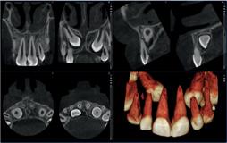 Więcej informacji, mniej promieniowania Protokół Planmeca Ultra Low Dose może być używany ze wszystkimi rozmiarami wokseli i we wszystkich trybach obrazowania, od normalnego trybu po endodontyczny.