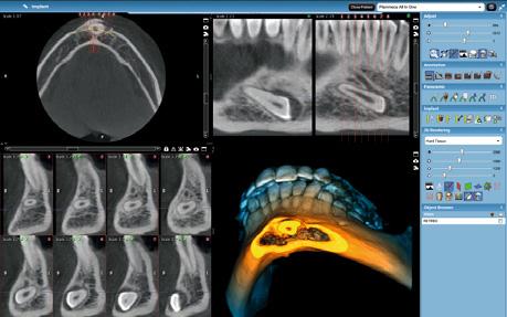 Proces z podpowiedziami umożliwia szybką segmentację całego uzębienia pacjenta. Modele powierzchni segmentowanych zębów mogą być wizualizowane, mierzone i wykorzystywane np.