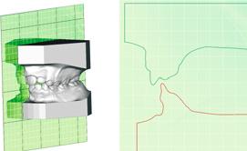 W celu lepszej wizualizacji można łączyć segmentowane z CBCT korzenie i powierzchnie kości.