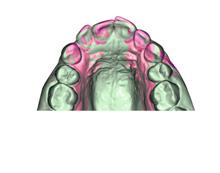 Analiza modelu dentystycznego Wyciski dentystyczne i odlewy gipsowe skanowane przy użyciu trybu skanowania modeli aparatu Planmeca ProMax 3D mogą zostać połączone ze wskaźnikiem zgryzu za pomocą