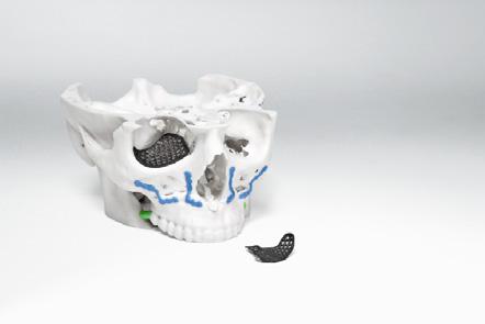 Dodatkowo dostępne są również fizyczne modele czaszki 3D oraz szablony chirurgiczne