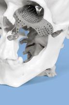Implanty 3D są projektowane podczas konferencji online między chirurgiem, a
