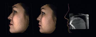 Bezpieczniejsza i szybsza chirurgia twarzy Zdjęcie 3D pokazuje tkankę miękką w kontraście z uzębieniem i kośćmi
