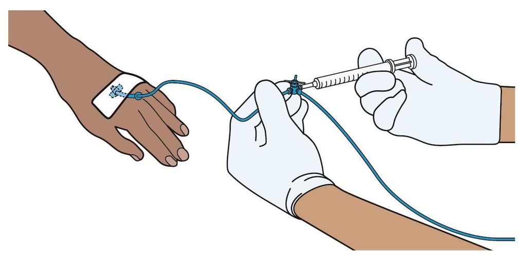 Having chemotherapy You will usually have your chemotherapy as a course of treatment sessions. Each session is followed by some rest days when you have no chemotherapy.