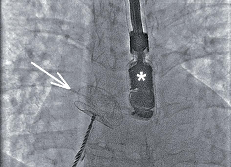 Table 2. Recommendations after procedure Tabela 2. Zalecenia po zabiegu Atrial septal defect Patent foramen ovale 1. Acetylsalicylic acid (325 mg) for 6 months, clopidogrel (75 mg) 1.