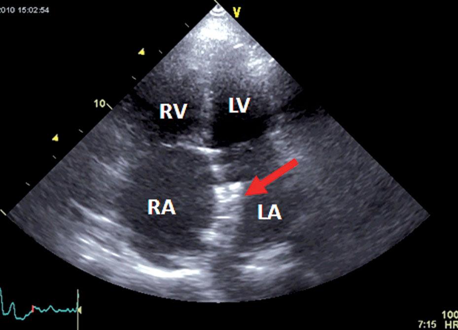 Standard prophylaxis of infective endocarditis for 6 months 3. Systematic echocardiographic control (transthoracic 3.
