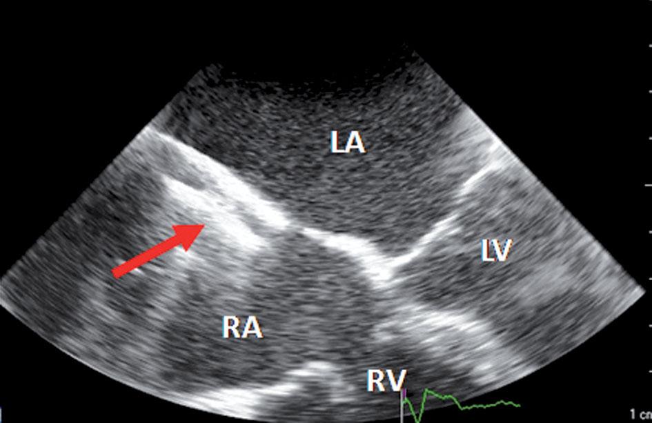 Avoidance of intense physical efforts for a month A B C D Fig. 1.