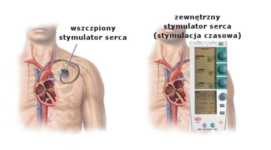 3. Wszczepialne urządzenia podtrzymujące rytm pracy serca Urządzenie o wysokości ok.