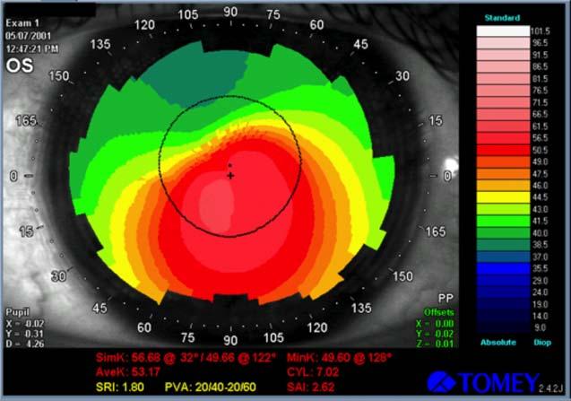 Można zatem uznać, że możliwość jednoczesnego pomiaru krzywizny i grubości rogówki w każdym jej punkcie stanowi bez