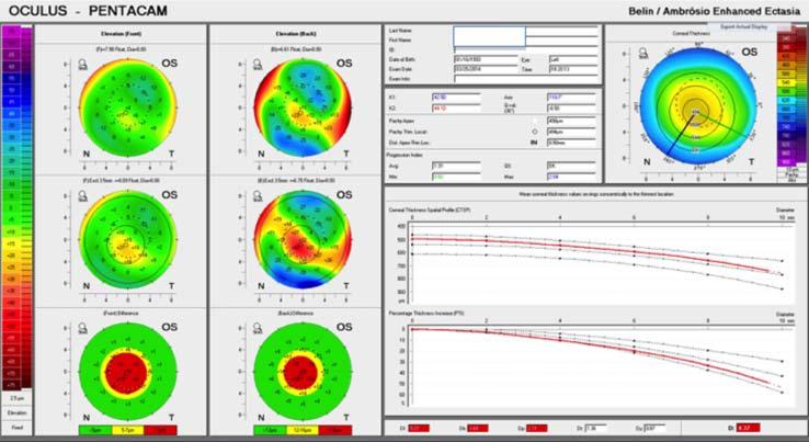74 ANNA M. ROSZKOWSKA Rycina 4. Przykład analizy wczesnego stożka rogówki przy pomocy programu Belin-Ambrosio Display (BAD), którym dysponuje tomograf Pentacam.