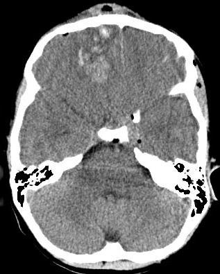 Diagnostyka obrazowe ostrych urazów głowy