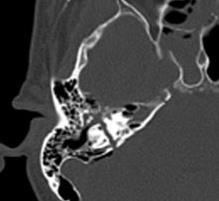 Diagnostyka obrazowa ostrych urazów głowy Złamania kości - szczególna uwaga na szczeliny
