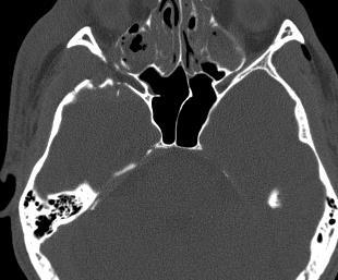 Diagnostyka obrazowa ostrych urazów głowy