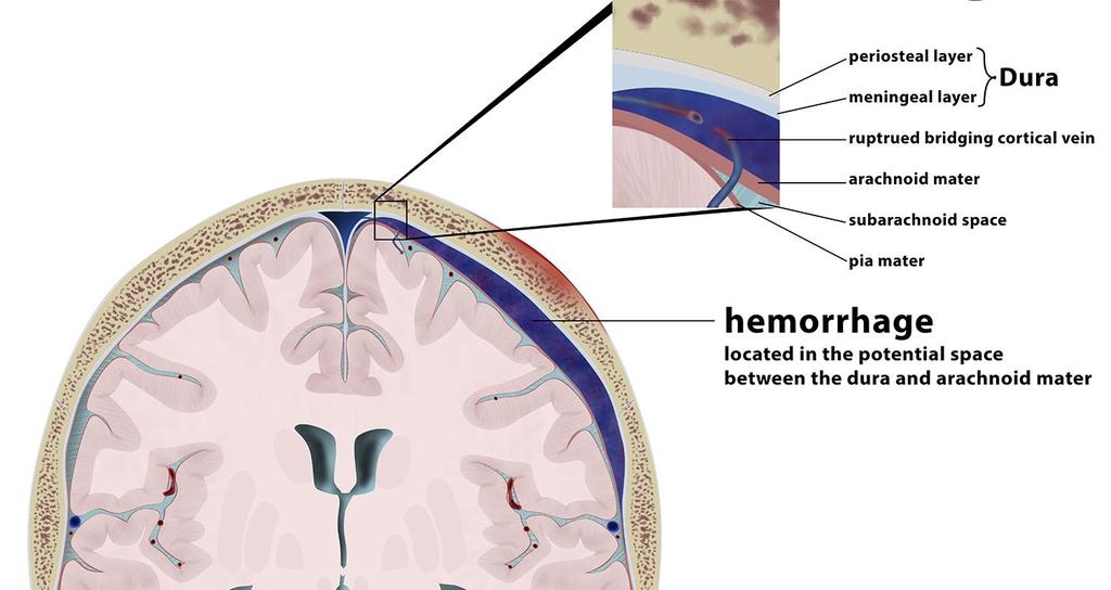 Primary Zmiany injuries urazowe in TBI pierwotne patients 1. Krwiak nadtwardówkowy (EDH) 2.