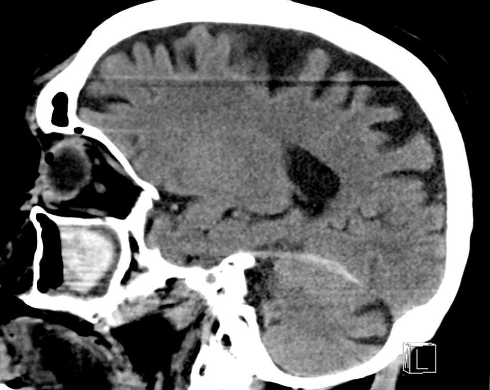 Primary Zmiany injuries urazowe in TBI pierwotne patients 1. Krwiak nadtwardówkowy (EDH) 2.