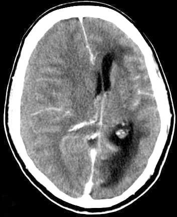 Primary Zmiany injuries urazowe in TBI pierwotne patients 1.