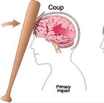 Zmiany urazowe pierwotne Obrażenia Coup - Głowa nieruchoma lub w ruchu uderzenie przez szybko