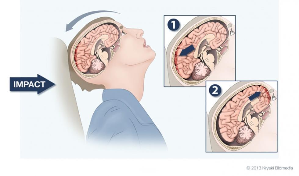 Zmiany urazowe pierwotne Obrażenia Contrecoup - Głowa szybko się porusza uderzenie w
