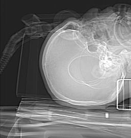 Diagnostyka obrazowa ostrych urazów głowy - Nie ma miejsca dla RTG - tylko informacja o