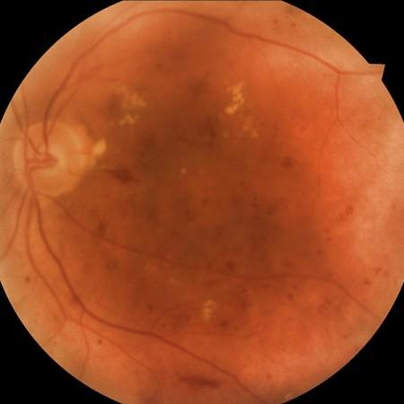 Diabetes Care 2012; 35:3, 592-596; 9. Garg S, Davis RM: Diabetic Retinopathy Screening Update. Clinical Diabetes. 2009; 27: 140-145 10. Luzio S, Hatcher S, Zahlmann G, et al.