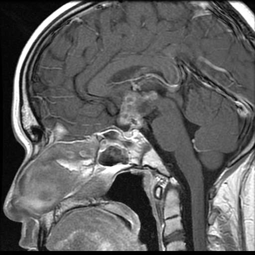 cech wznowy guza. Chłopiec stale pozostaje pod opieką Poradni Endokrynologicznej. Dyskusja Ryc. 1. Obraz MRI pacjenta widoczny guz okolicy podwzgórzowo-przysadkowej (przekrój strzałkowy) Fig. 1. Sagittal MRI showing a mass lesion in the hypothalamic-pituitary area Ryc.
