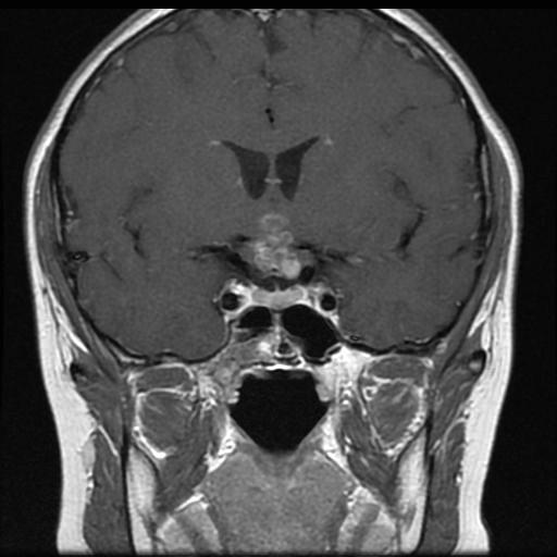 Coronal MRI showing a mass lesion in the hypothalamic-pituitary area W pracy przedstawiono przypadek guza craniopharyngioma u 16,5-letniego chłopca, który został skierowany do Oddziału Endokrynologii
