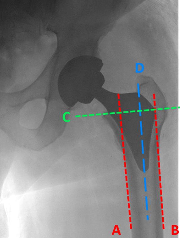 Figure 1 Radiological determination of endoprosthesis Proxima stem position in marrow cavity of proximal stump of femur using the authors own method correct position.