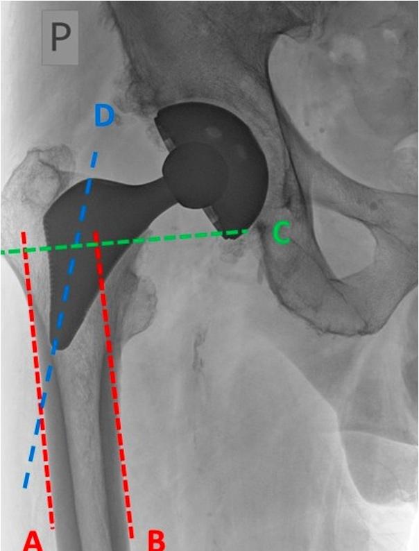 Figure 2 Radiological determination of endoprosthesis Proxima stem position in marrow cavity of proximal stump of femur using authors own method Varus position.