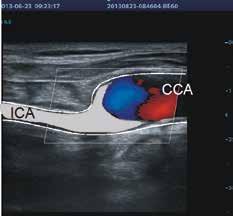 Przepływ w tętnicy szyjnej wspólnej; C. Przepływ w miejscu zwężenia zaawansowania zmian miażdżycowych. Średnica poszczególnych kanałów zmienia się powtarzalnie w trakcie kolejnych cyklów pracy serca.