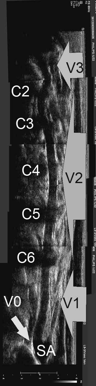 7): V 0 miejsce odejścia tętnicy kręgowej od tętnicy podobojczykowej; V 1 obejmuje fragment od odejścia od tętnicy podobojczykowej do wejścia do otworu wyrostka poprzecznego 6. kręgu szyjnego (w ok.