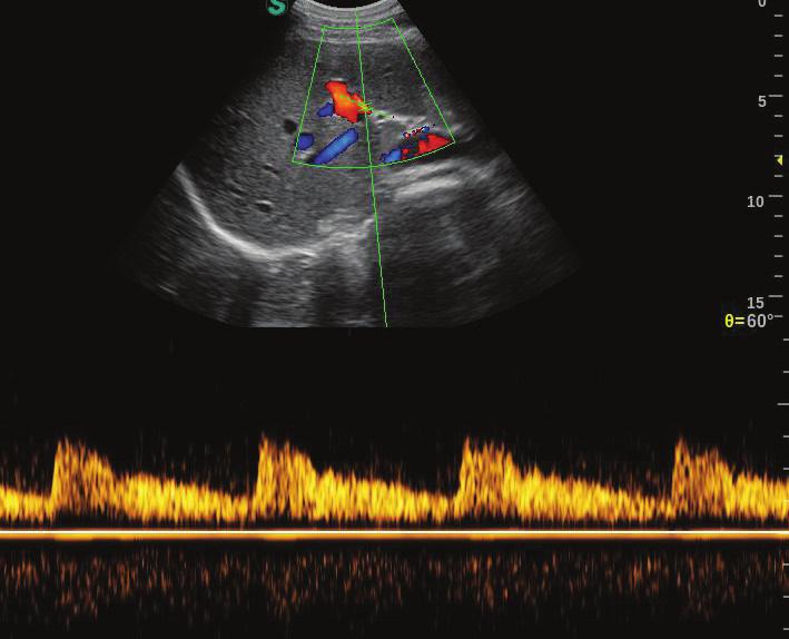 przenośny SonoScape S2 Kolorowy Doppler Doppler Pulsacyjny (PW HPRF) Doppler Ciągły CW (opcjonalnie) automatyczny obrys i obliczenia parametrów przepływy w trybie Dopplera technika obrazowania