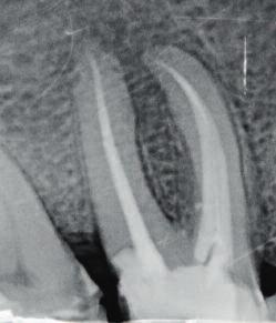 Ryc. 2: Pooperacyjne zdjęcie rentgenowskie po zakończeniu leczenia kanałowego.