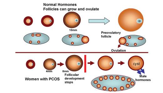 PCOS rozpoznanie (2) USG W co najmniej jednym jajników 12 lub więcej pęcherzyków o średnicy 2-9 mm LUB Objętość jajnika >10 cm 3 Stwierdzenie pęcherzyka > 10 mm lub ciałka żółtego à USG