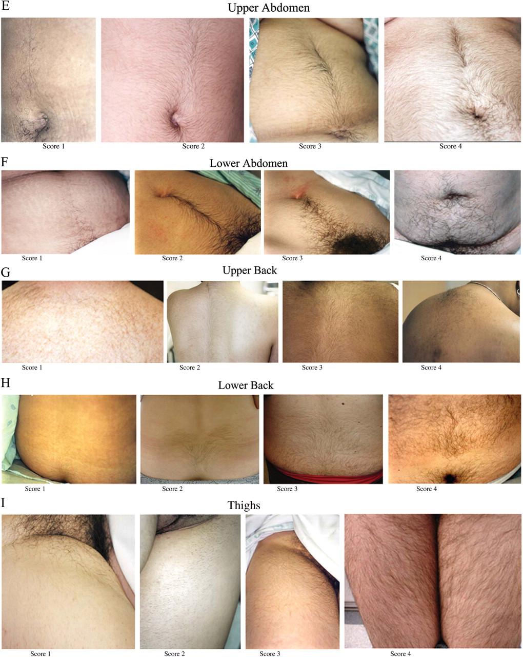 Skala Ferrimana-Gallweya Yildiz et al. Visually scoring hirsutism. Hum Reprod Update.