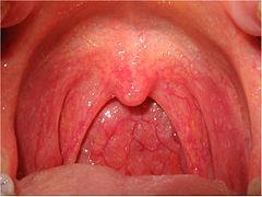 Ostre wirusowe zapalenie gardła OBJAWY ból gardła suchość w gardle drapanie, pieczenie, kłucie ból promieniujący do ucha OGLĄDANIE przekrwiona błona śluzowa grudki