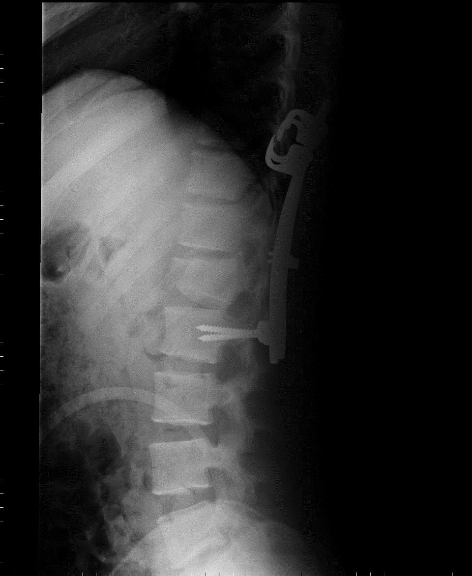 kręgosłupa L2-Th11 śrubowo-hakowa ze spondylodezą