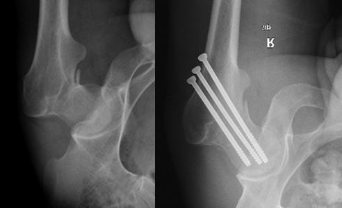 Dudko S. i wsp. Wybór metody leczenia złamań krętarzowych oraz szyjki kości udowej Ryc. 2. Stabilizacja wewnętrzna przy użyciu kaniulowanych śrub szyjkowych Fig. 2. Internal fixation with cannulated hip screws Tab.