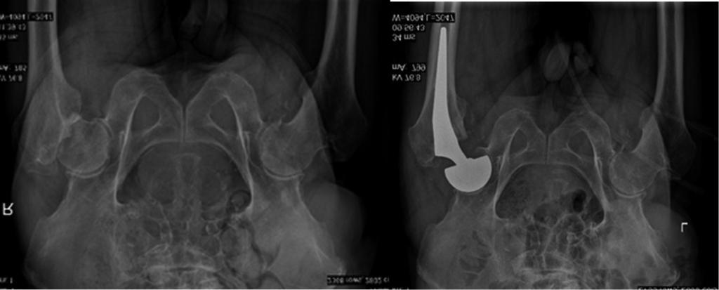Total hip replacement (non-cemented) Ryc. 4.