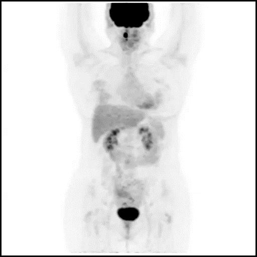 FDG PET/CT