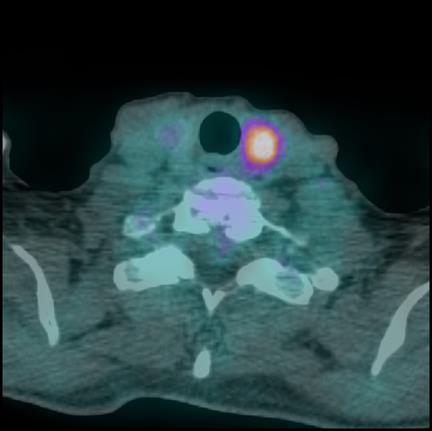 płacie tarczycy w badaniu PET-CT u pacjenta z