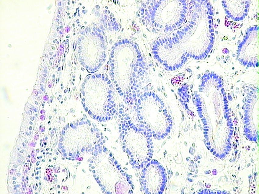 202 Medycyna Wet. 2010, 66 (3) n¹ charakterystyczn¹ dla danej kategorii endometrosis. W ocenie stopnia nasilenia w³óknienia zrêbu endometrium (liczba warstw torebki w³óknistej wokó³ tzw.