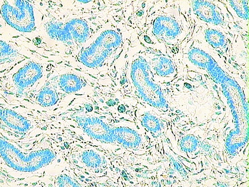 Endometrosis macicy klaczy, kategoria IIb, w zrêbie widoczne rozsiane eozynofile. Bioptat b³ony œluzowej macicy klaczy. HE 40 Ryc. 5.